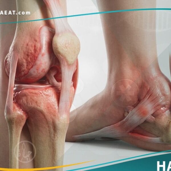 متلازمة رايتر