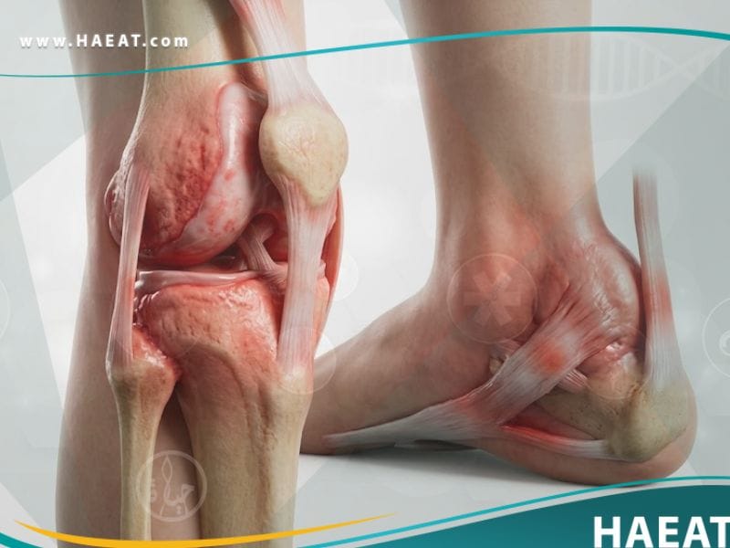 متلازمة رايتر