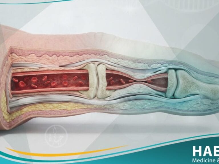 متلازمة رايوناود