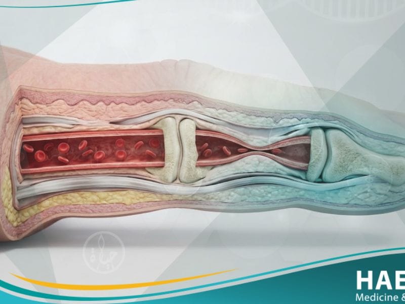 متلازمة رايوناود