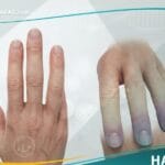 _متلازمة رايوناود