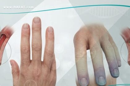 _متلازمة رايوناود