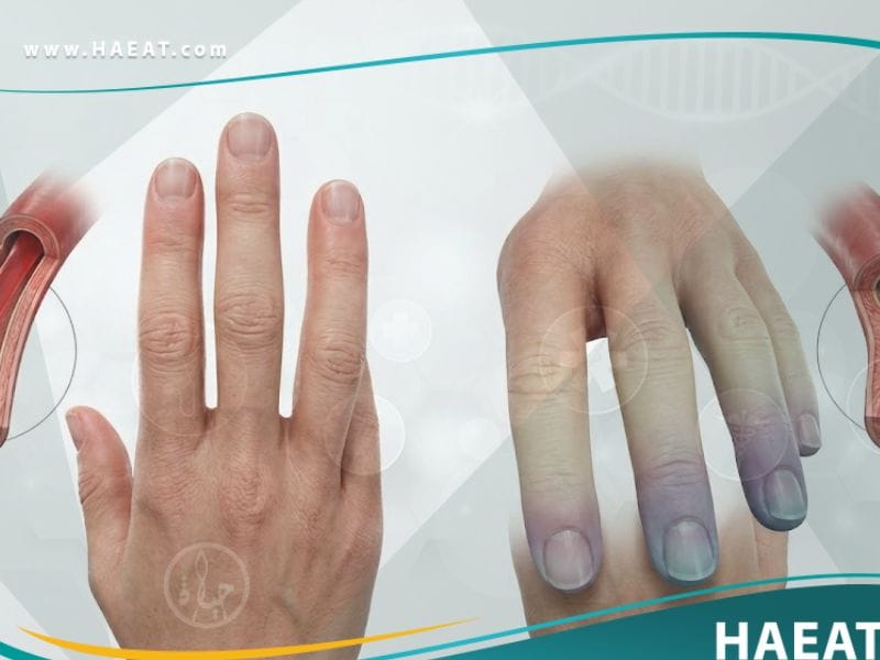 _متلازمة رايوناود