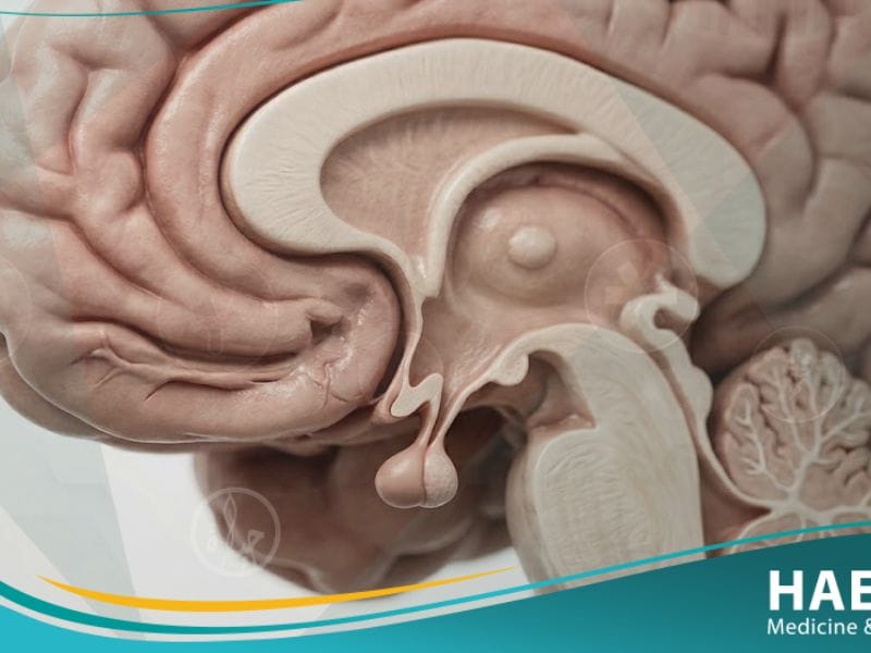 متلازمة كالمان