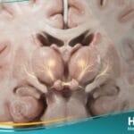 متلازمة كورساكوف