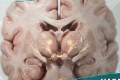 متلازمة كورساكوف