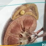 متلازمة كون