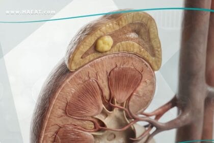 متلازمة كون