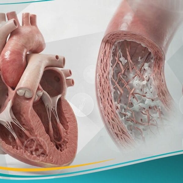 متلازمة مارفان (1)