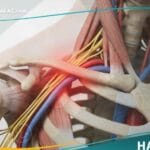 _متلازمة مخرج الصدر