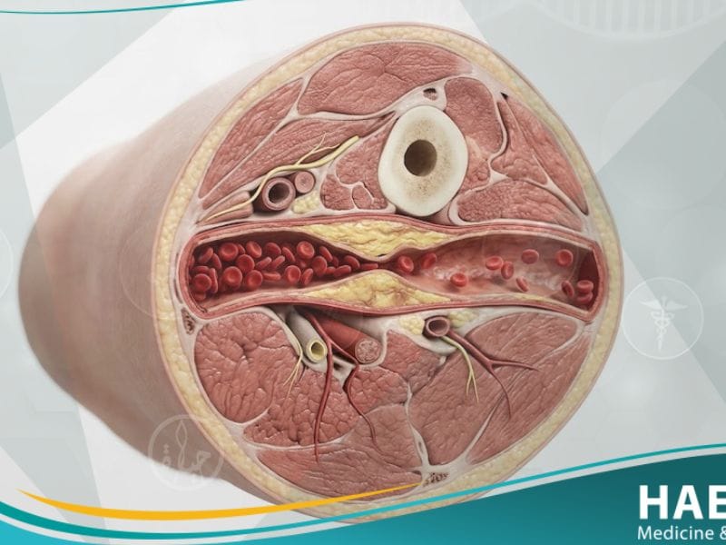 _مرض الأوعية الدموية المحيطية