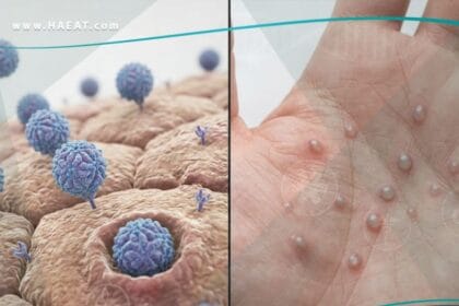 مرض اليد والقدم والفم