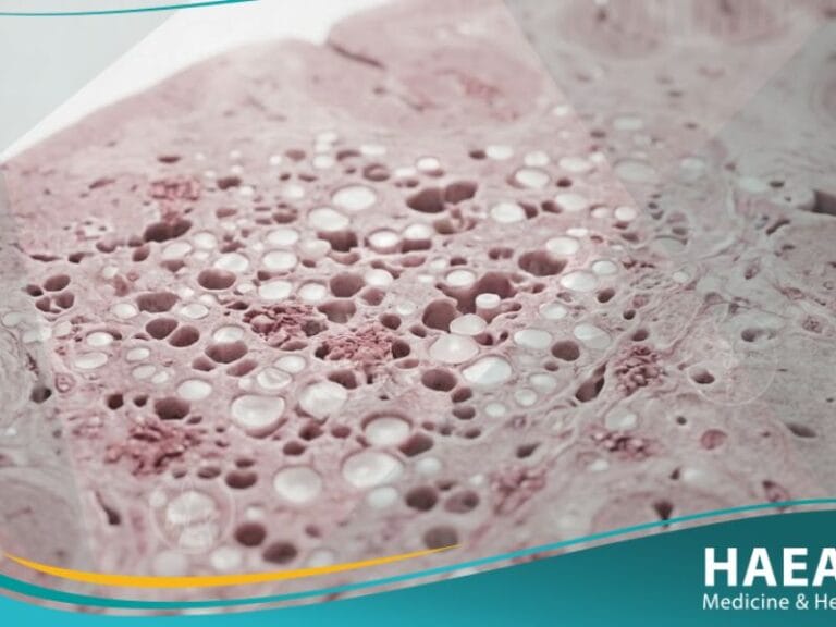 _مرض جنون البقر