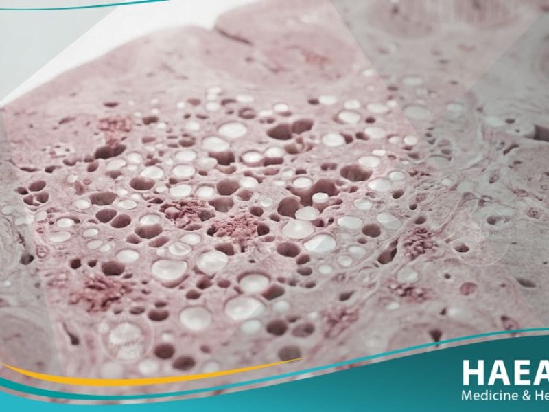 _مرض جنون البقر