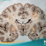 _مرض كروتزفيلد جاكوب (1)