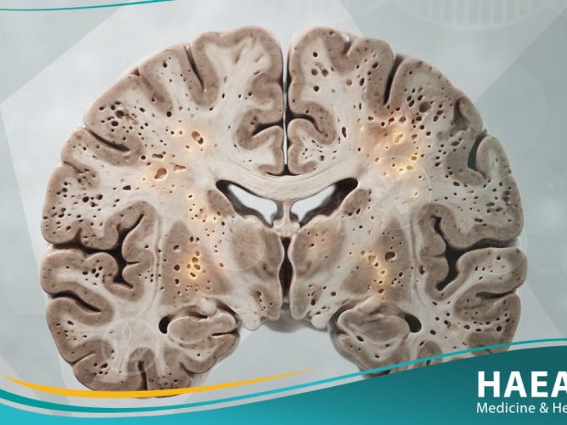 _مرض كروتزفيلد جاكوب (1)