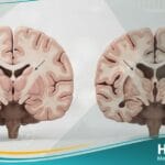 مرض هنينغتون