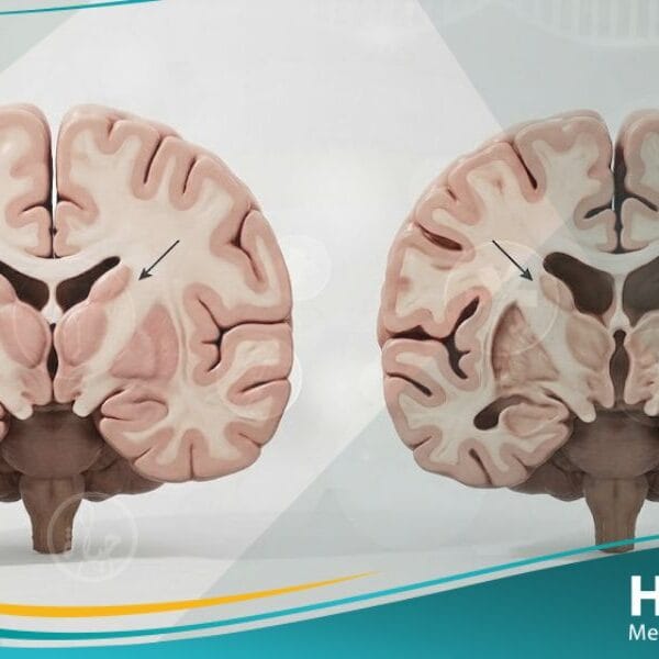 مرض هنينغتون