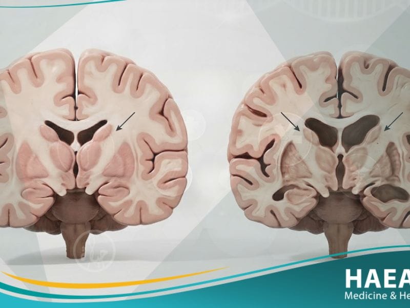 مرض هنينغتون