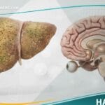 _مرض ويلسون