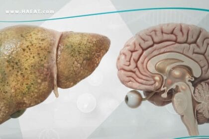 _مرض ويلسون