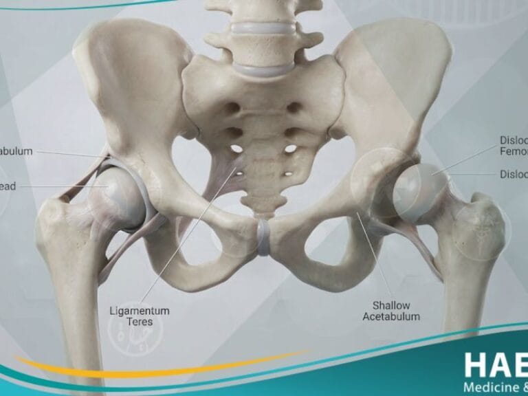 _مفصل الورك