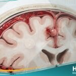 نزف تحت العنكبوتية