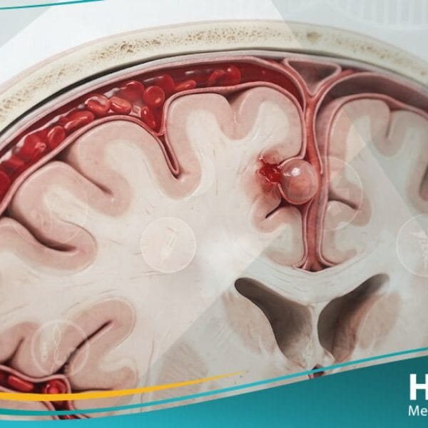 نزف تحت العنكبوتية