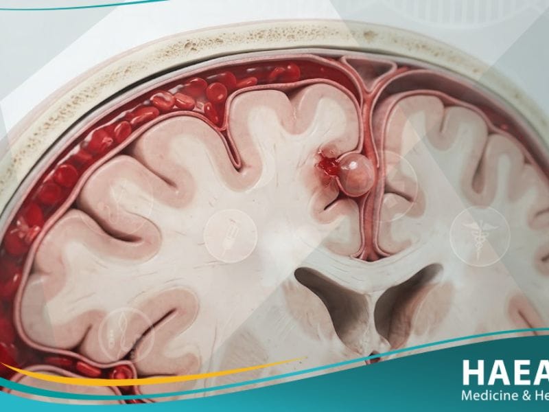 نزف تحت العنكبوتية