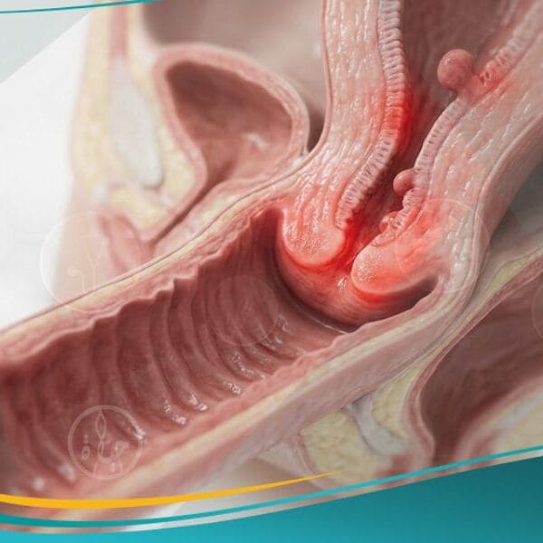 نزيف ما بعد ممارسة الجنس