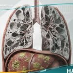 نقص ألفا 1 - أنتي تريبسين