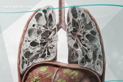 نقص ألفا 1 - أنتي تريبسين