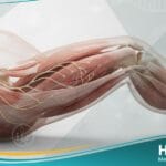 نقص توتر العضلات