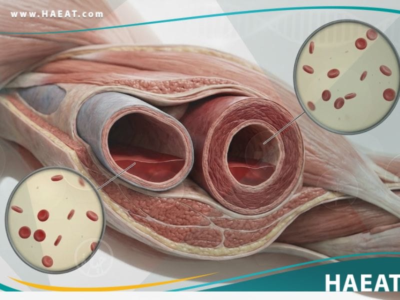 _نقص حجم الدم