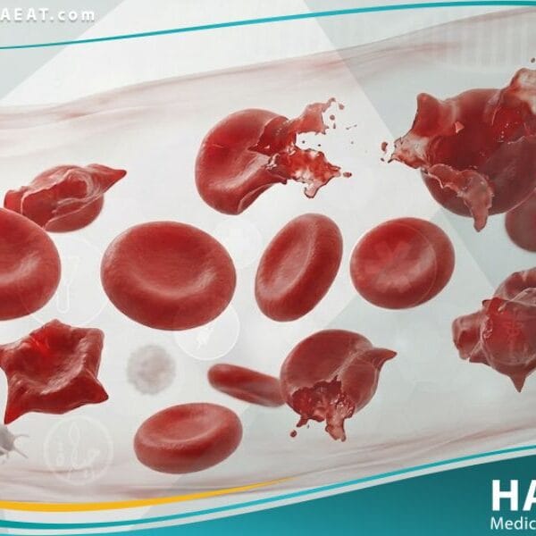 نقص نازعة هدروجين 6 - فوسفات الغلوكوز