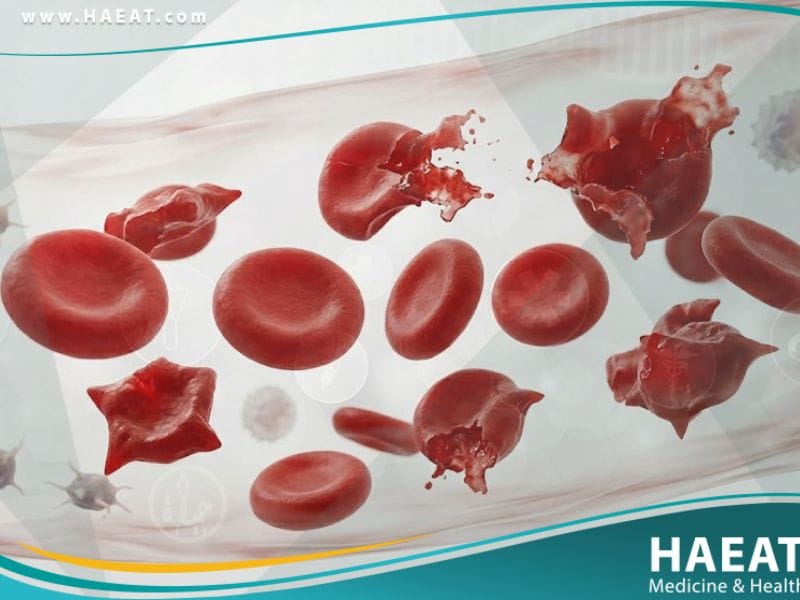 نقص نازعة هدروجين 6 - فوسفات الغلوكوز