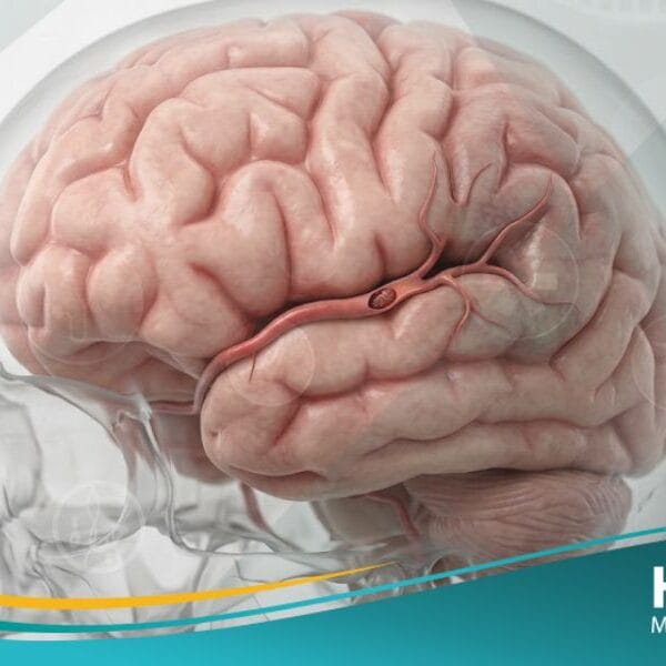 نوبة إقفارية عابرة