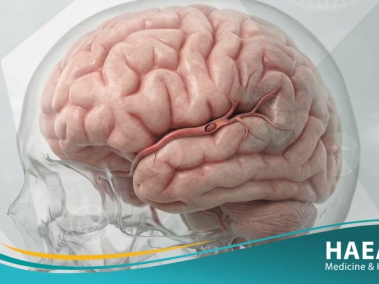 نوبة إقفارية عابرة