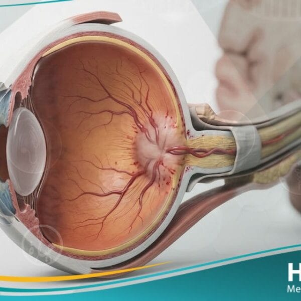 وذمة حليمة العصب البصري