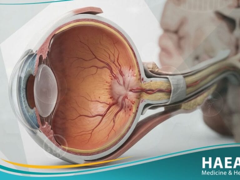 وذمة حليمة العصب البصري