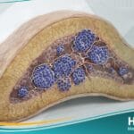 _ورم أرومي عصبي