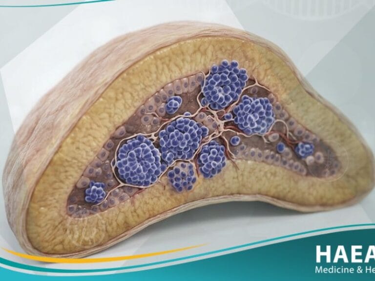 _ورم أرومي عصبي