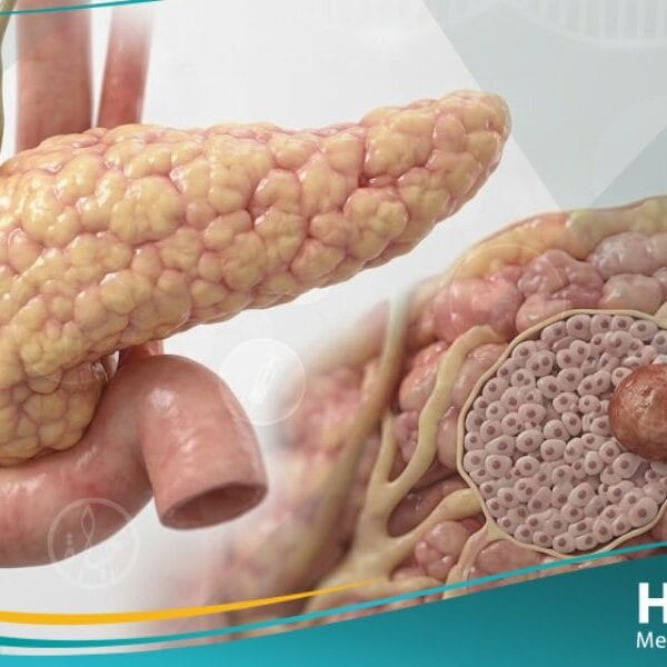 ورم إنسوليني