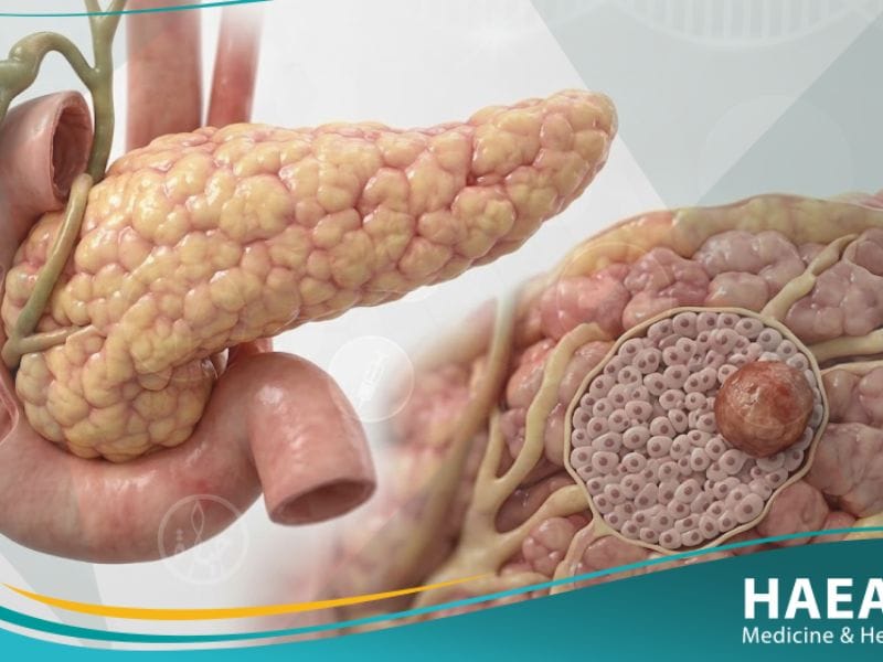 ورم إنسوليني