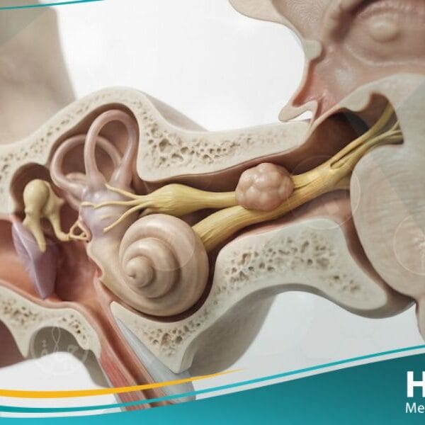 ورم غمد الليف العصبي السمعي