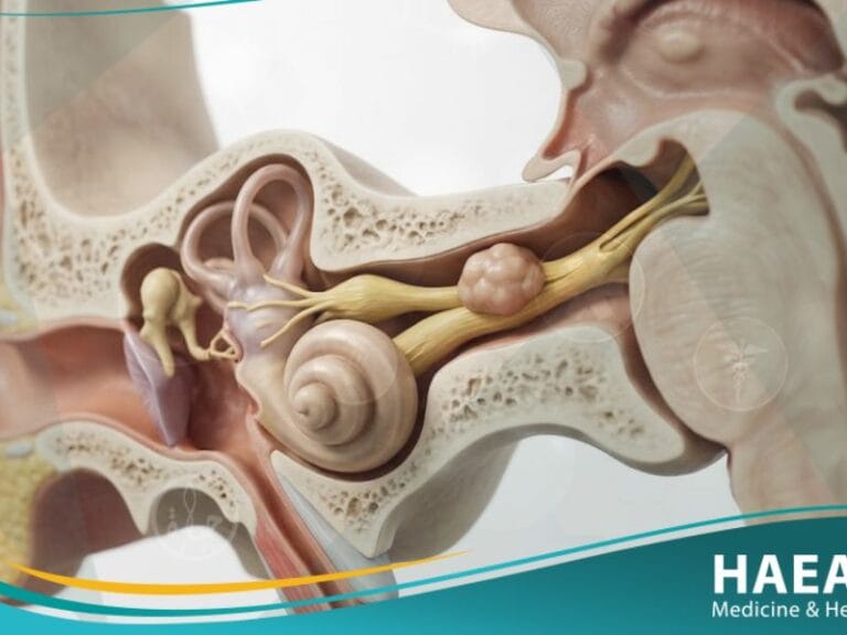 ورم غمد الليف العصبي السمعي