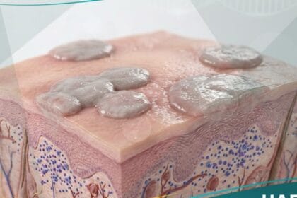 ورمٌ لقميٌ مسطح