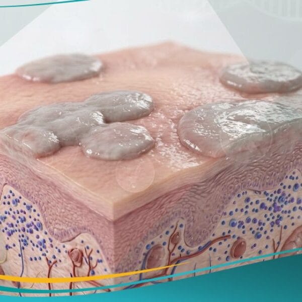 ورمٌ لقميٌ مسطح