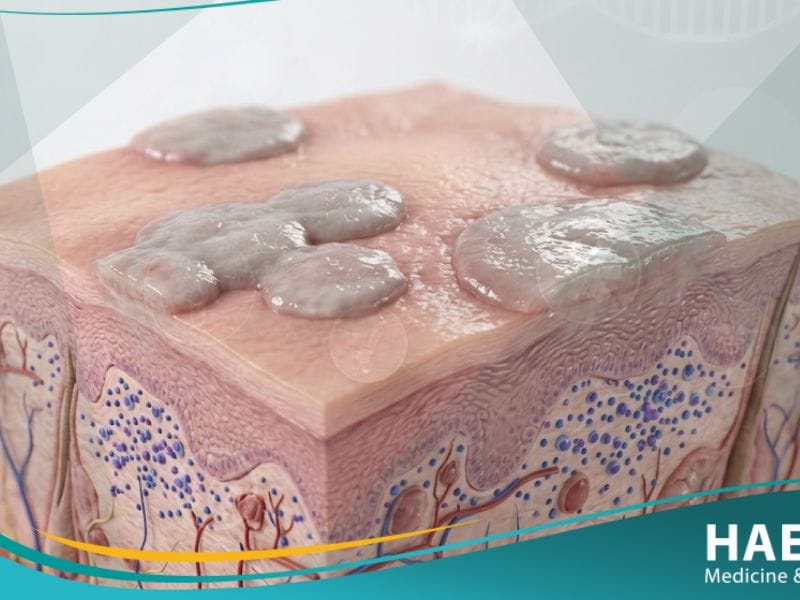 ورمٌ لقميٌ مسطح