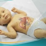 يرقان الرضع